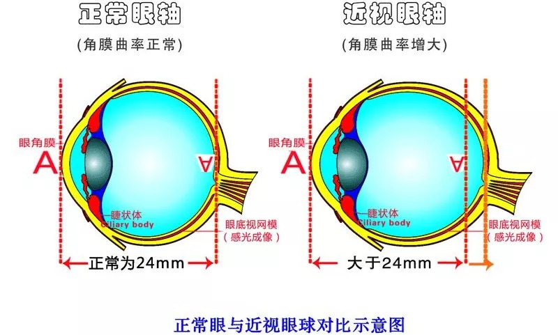 全球前沿近视矫正技术揭秘